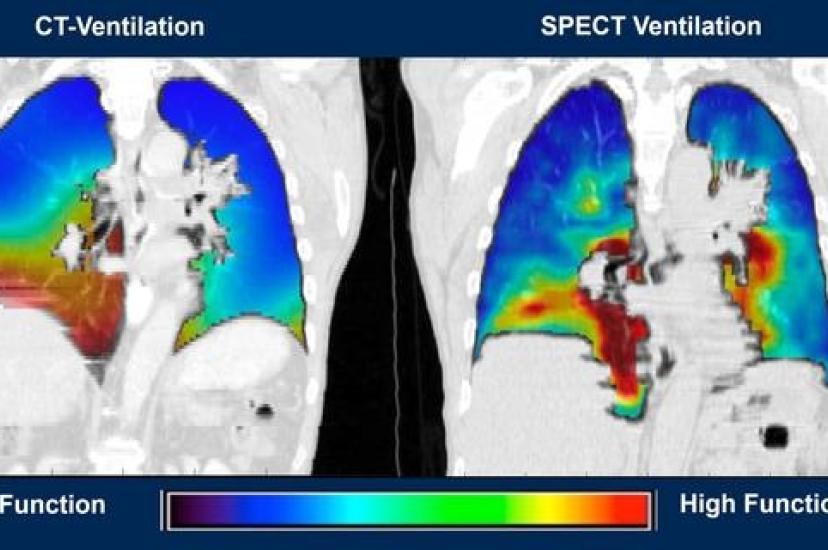 CT lung software 
