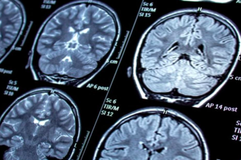 The new pipleine of approaches has allowed for exploration of Alzheimer’s disease in human brains 