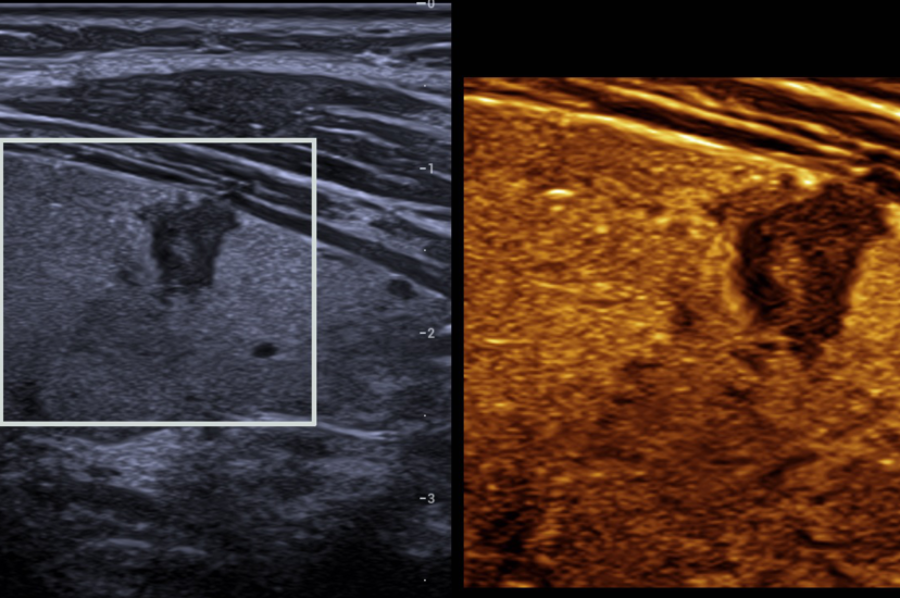 Resona’s HDScope+ used for thyroid nodule inspection