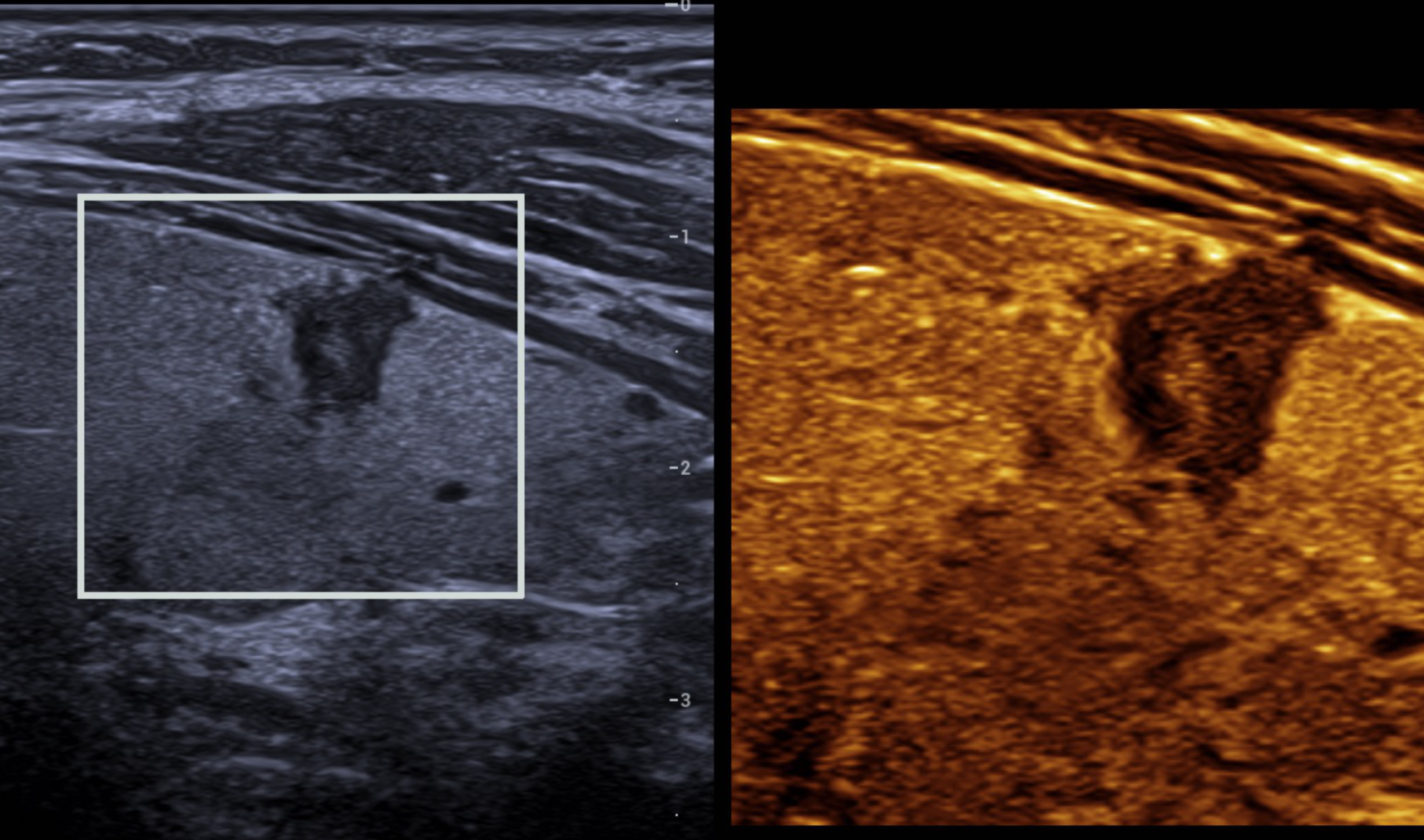 Resona’s HDScope+ used for thyroid nodule inspection