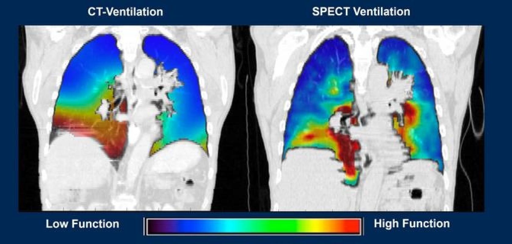 CT lung software
