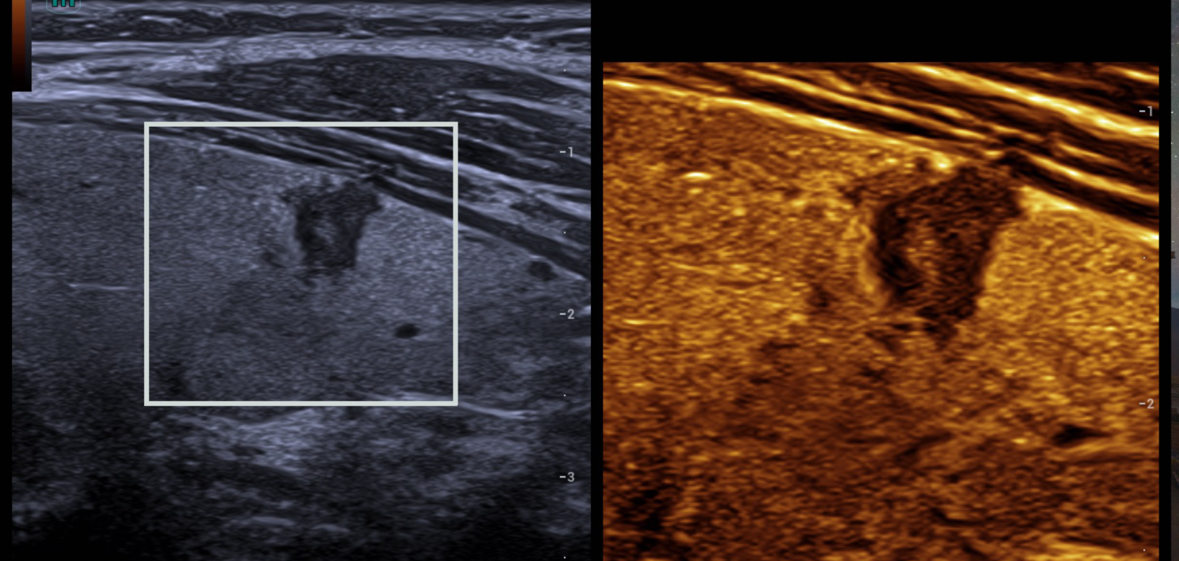 Resona’s HDScope+ used for thyroid nodule inspection