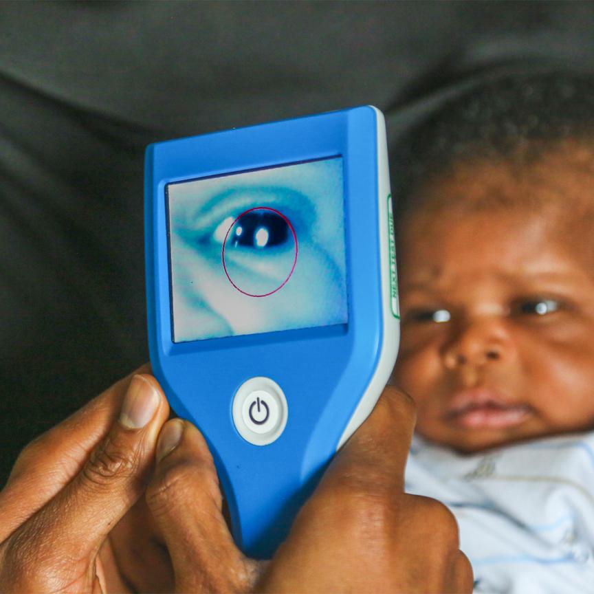 Neocam can be used to detect congenital cataracts in newborns