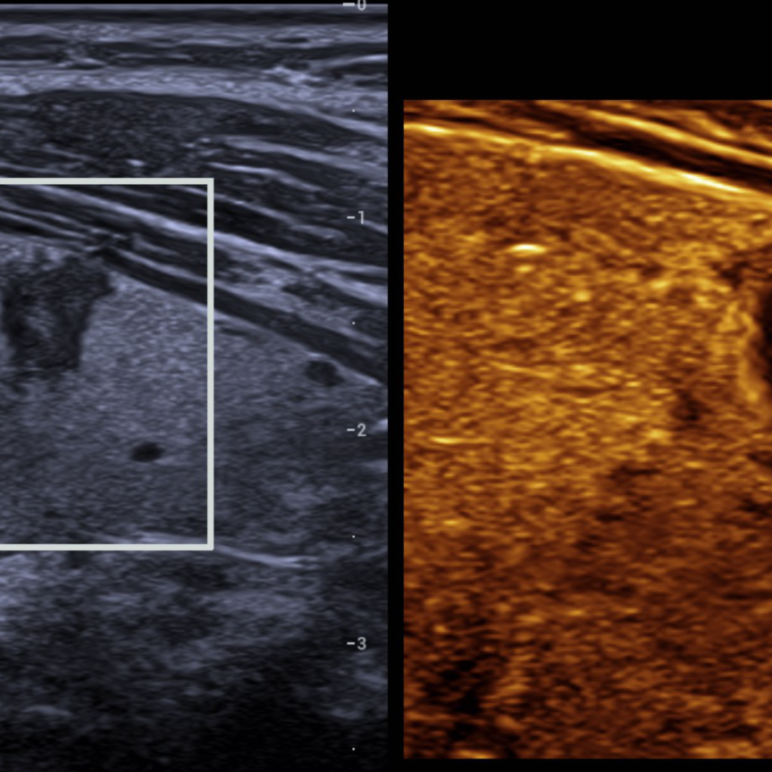 Resona’s HDScope+ used for thyroid nodule inspection